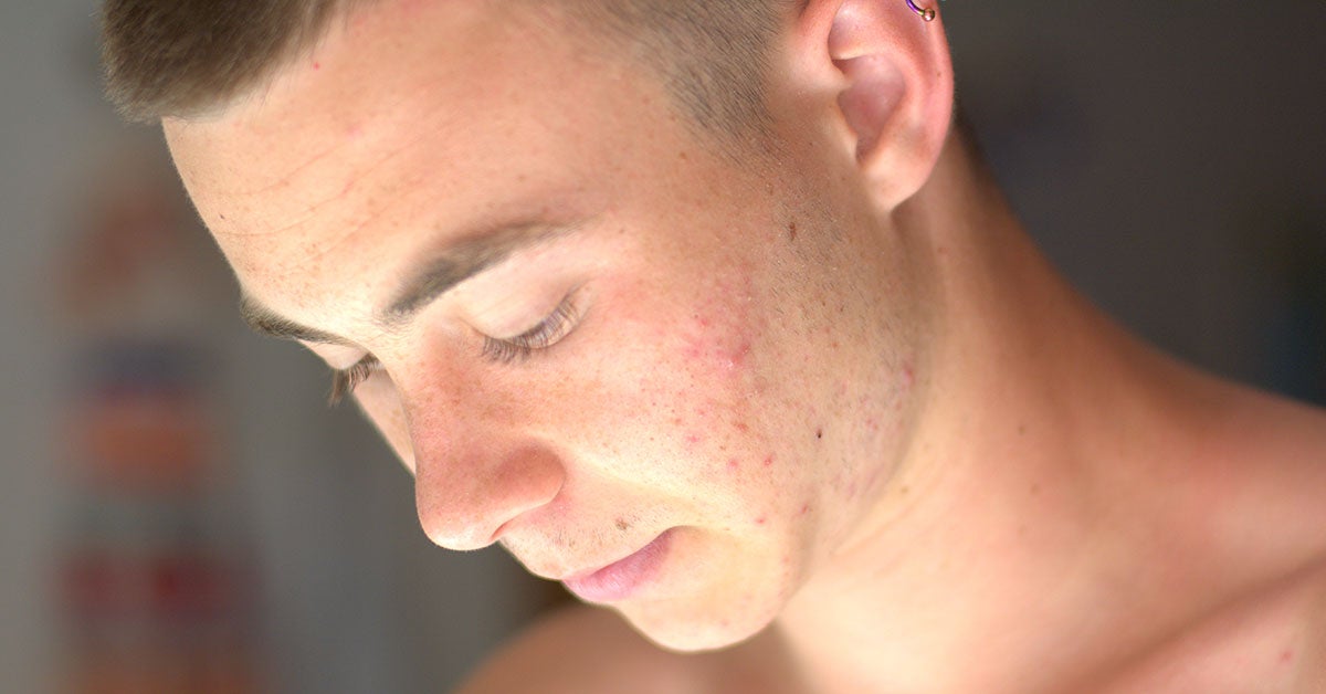 Tretinoin For Acne Usage Benefits Efficacy And Side Effects