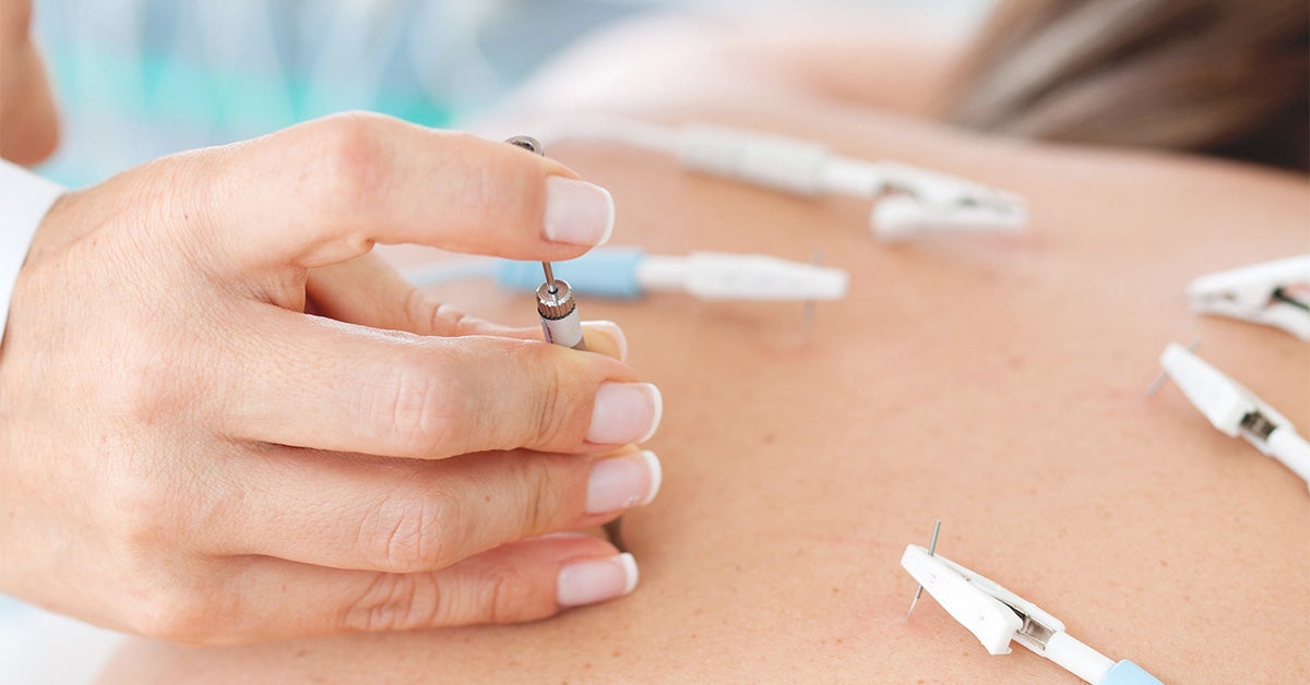 Electroacupuncture Uses, Process, Evidence, Side Effects, and Safety