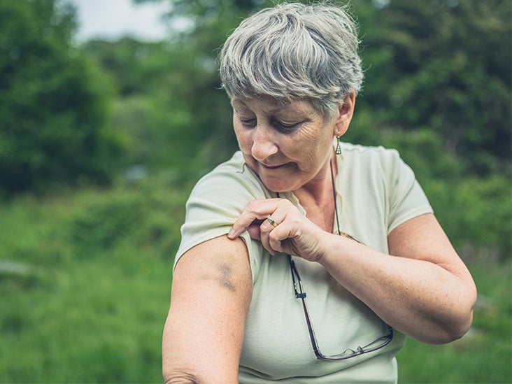 sore-spot-on-breast-feels-like-a-bruise-signs-of-inflammatory-breast