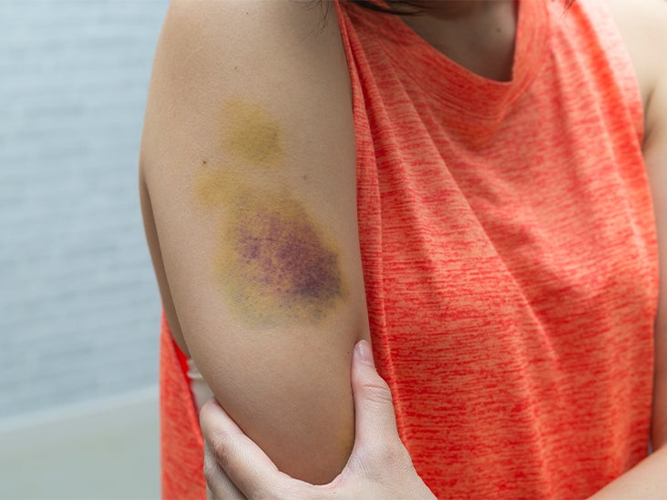 Bruise Itch Causes Risk Factors And Treatment