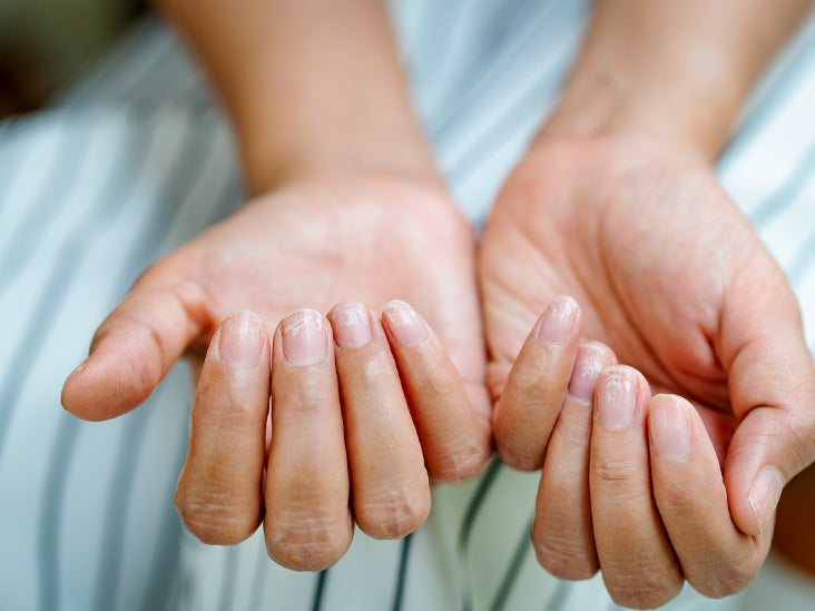 Psoriasis fingernails 
