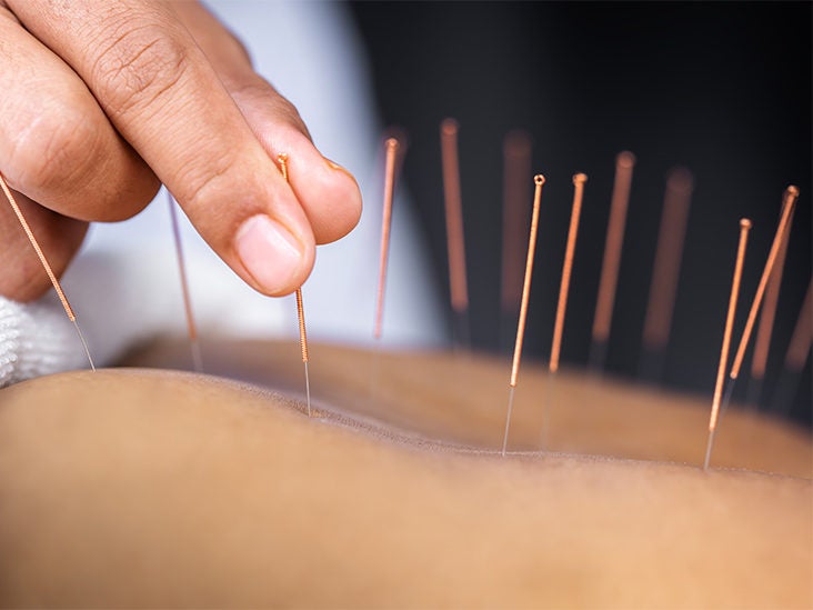 West Palm Beach Acupuncturist