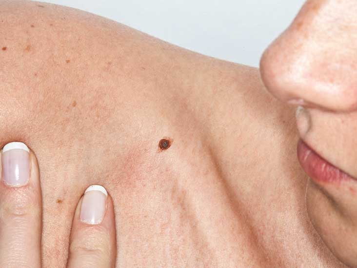 Skin Cancer Pictures and Facts: What You Need to Know