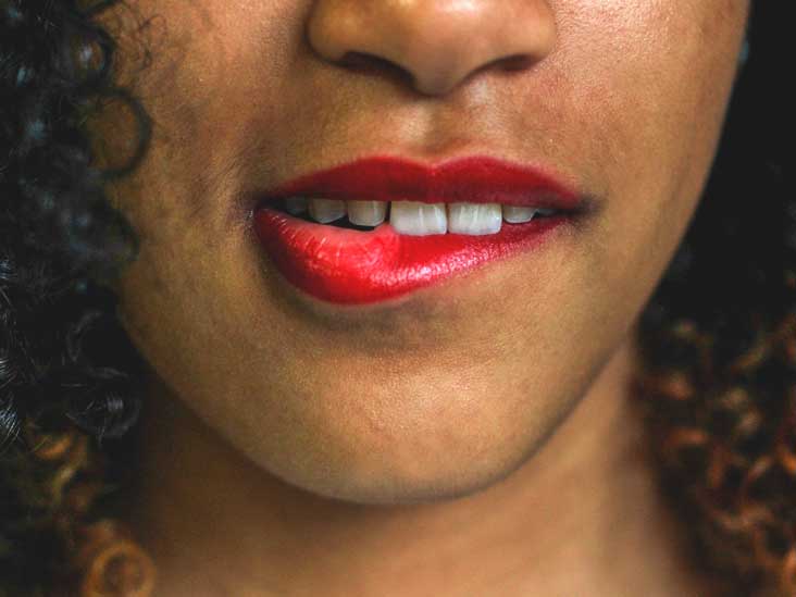 Chipped Tooth Causes, Treatment, Recovery