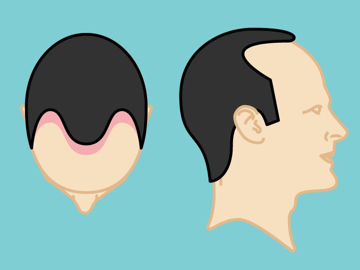 Receding Hairline Stages Causes And Treatments