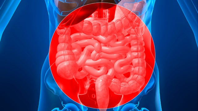 Ischemic Colitis: Causes, Symptoms, and Diagnosis