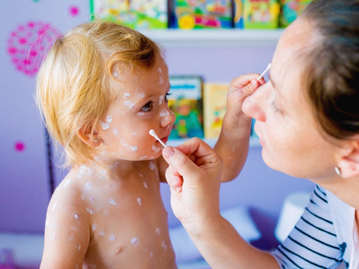 chicken pox in kids