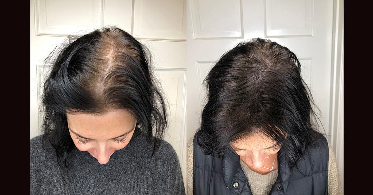Scalp Micropigmentation: Benefits, Side Effects, Before & After Pics