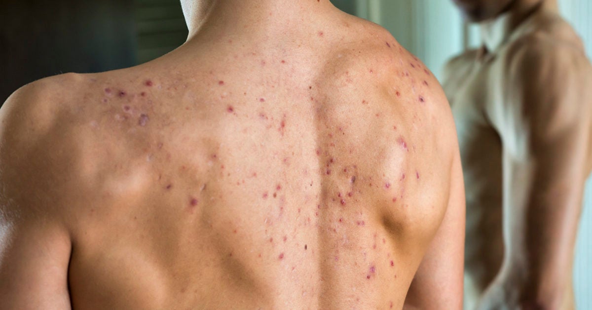 Cystic Acne on Back: Causes and Treatment