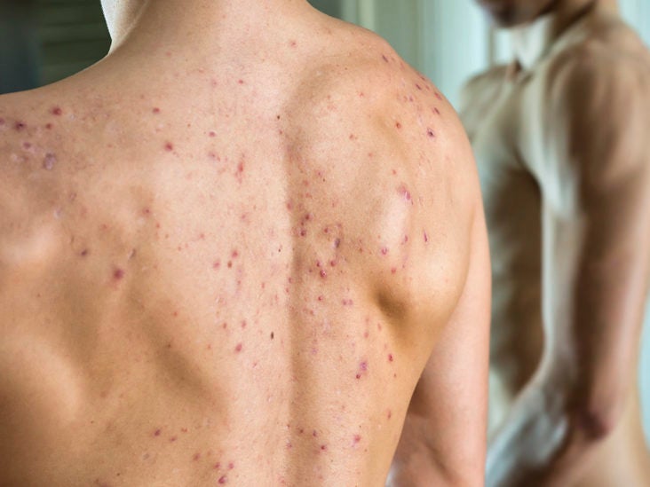 reduce cystic acne