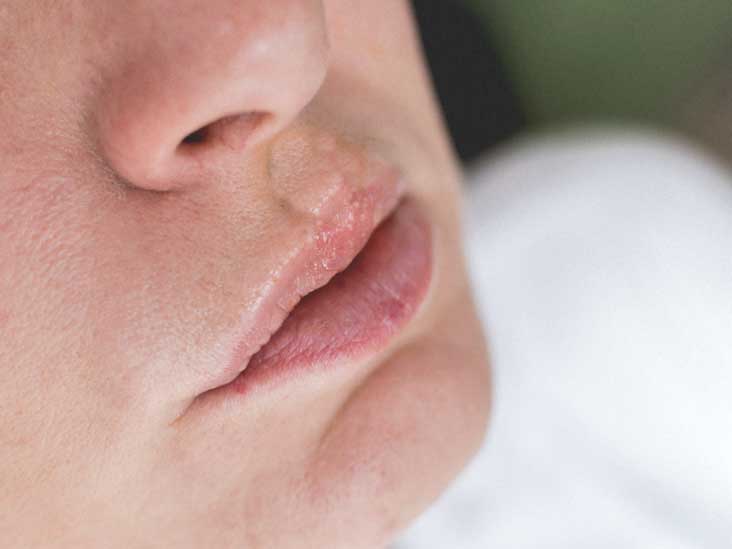 swollen-lips-causes-treatment-and-more