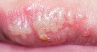 Pearly penile papules severe Cutaneous Penile