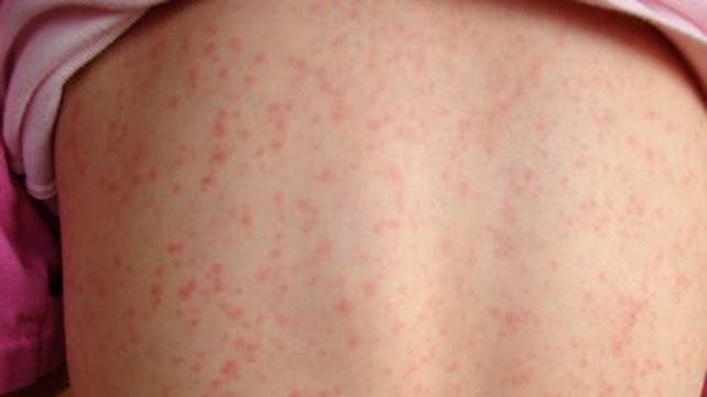 Scarlet Fever Symptoms, Causes, Complications, and Treatment