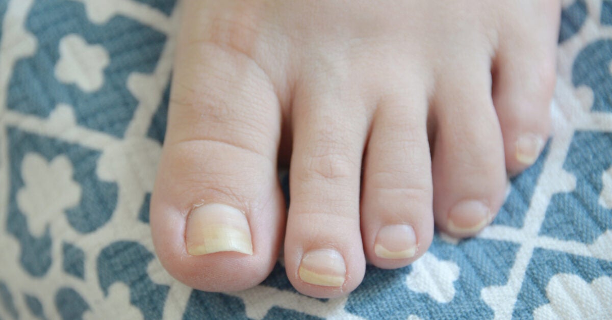 yellow-toenails-causes-prevention-and-treatments