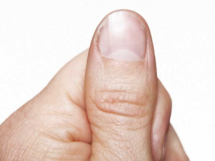 White Spots On The Nails Causes And More