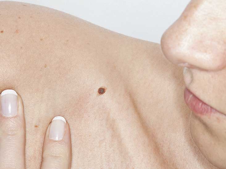 Itchy Mole Causes Treatment Symptoms And More