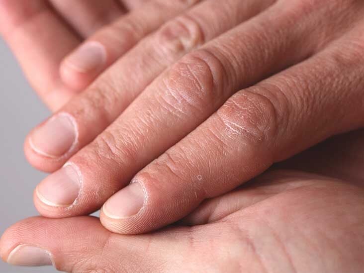 Hpv warts hands Warts on hands from stress - Warts on hands from stress