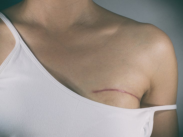 Breast Cancer Treatment Options By Stage From 0 To 4