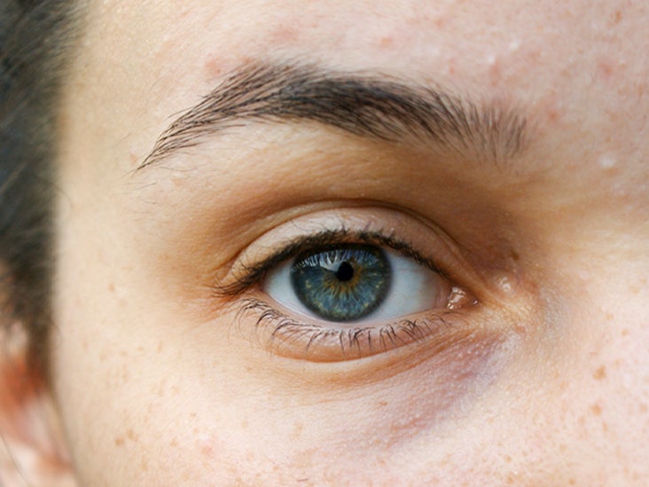 wrinkled eyelids home remedy