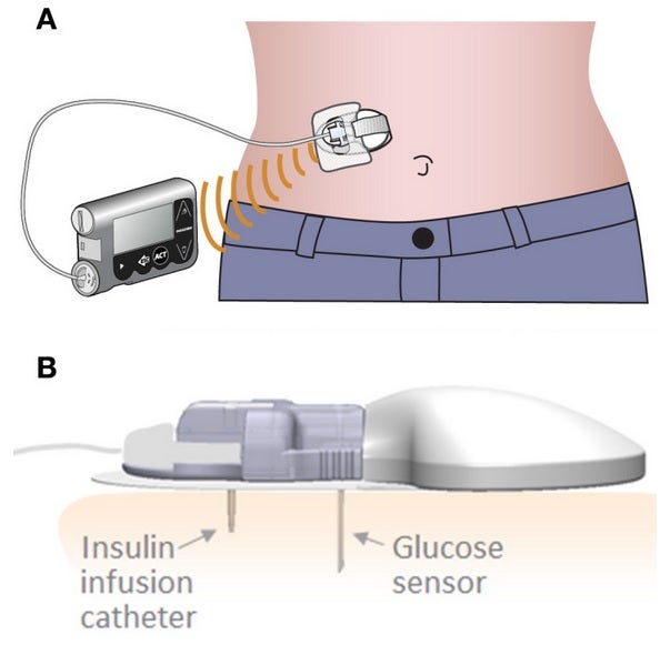 NewsFlash: New dual diabetes device from Medtronic