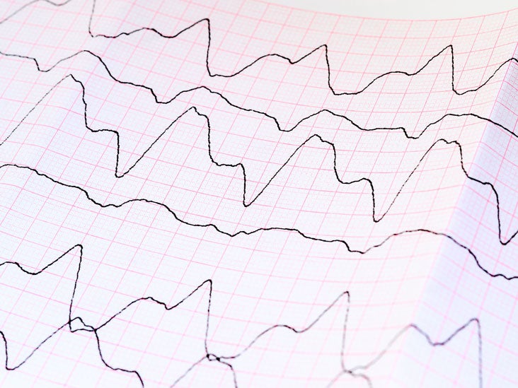 Atrial Fibrillation Blood Clots Symptoms, Prevention, and More