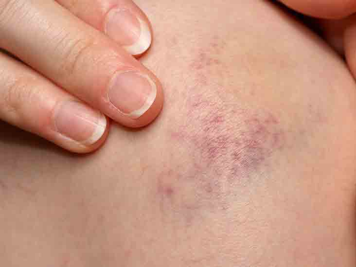 blood clot under skin blood clot under skin