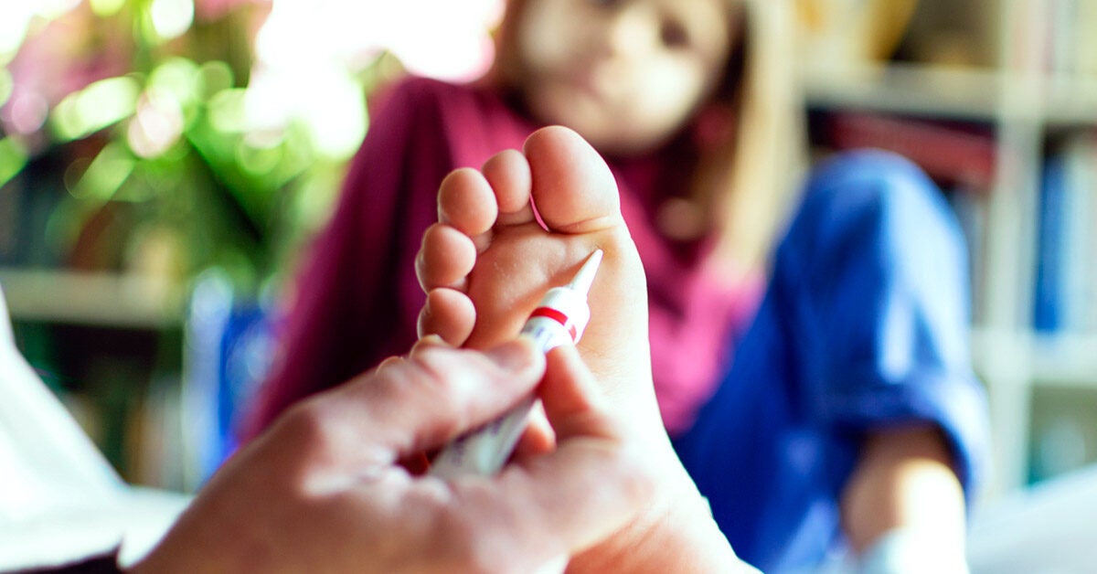 Salicylic Acid Wart Removal Tips