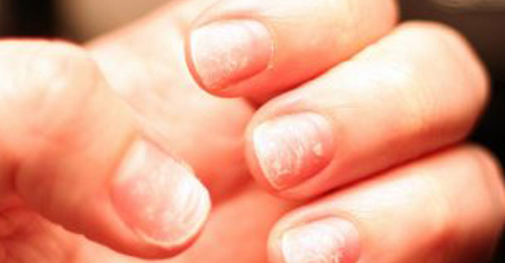 Nail Pitting Treatment At Home 