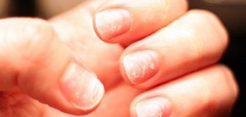What Do Nail Problems Mean For Your Health 