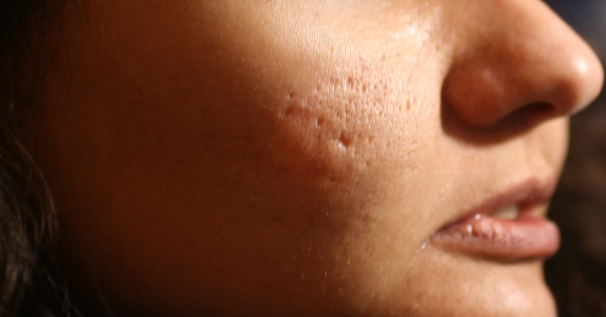 Types Of Acne Scars And How To Get Rid Of Them All