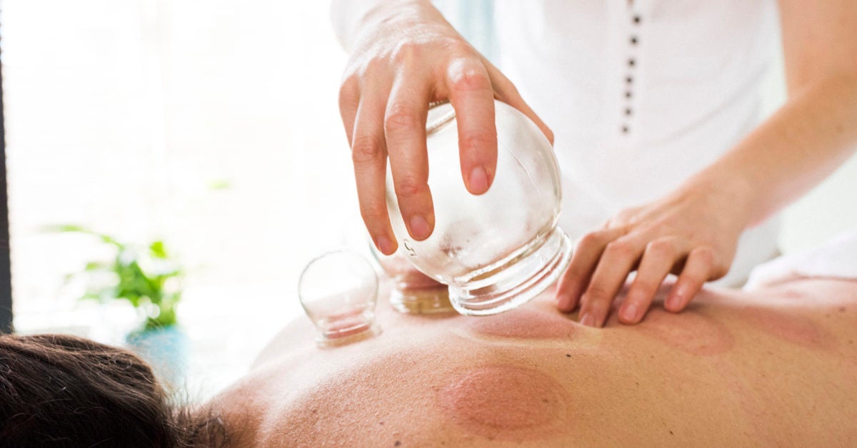 Cupping Therapy What Is It and Should You Try It?