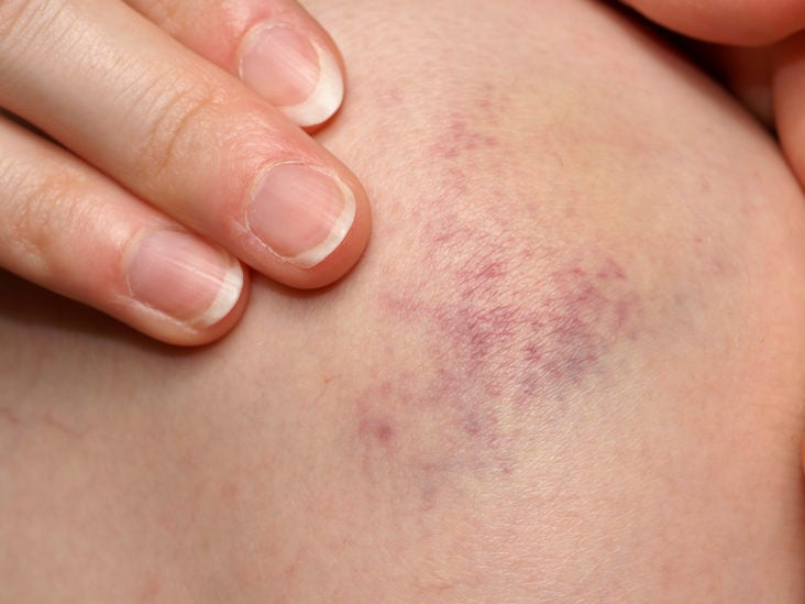 Bruising Easily Should I Be Worried If I Bruise Easily