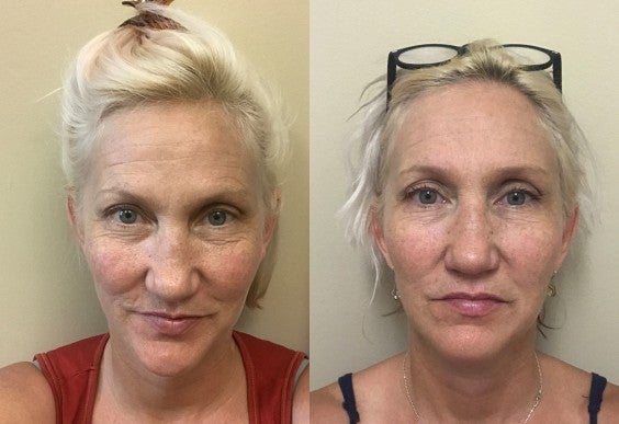 Two photos of the author, before and after face yoga