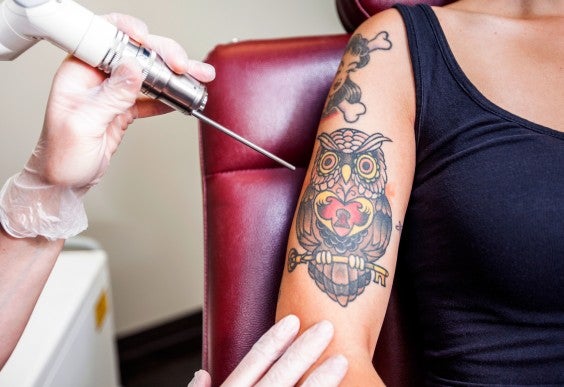 1. Laser Tattoo Removal