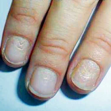 Dents nails have Ridges in