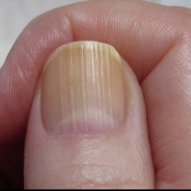 In fingernails dents tiny What do