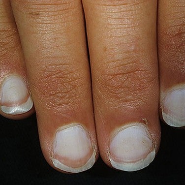 On fingernails indents small Why Does