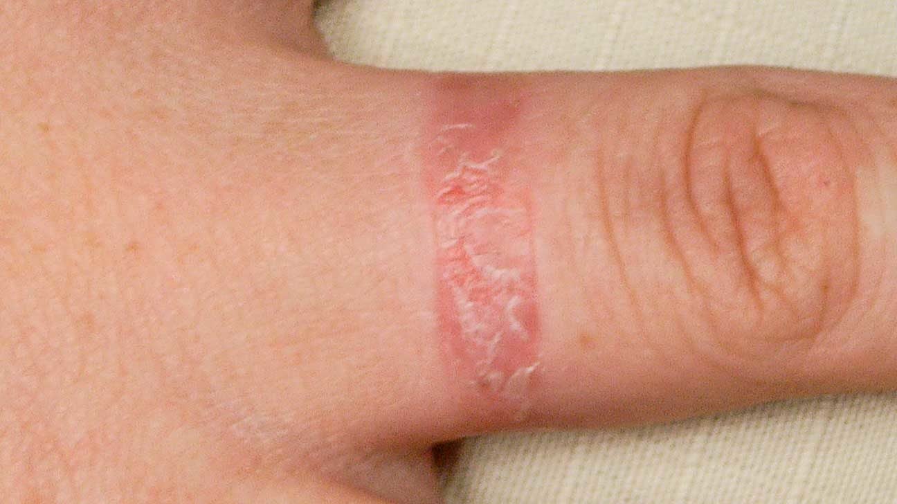 contact dermatitis finger