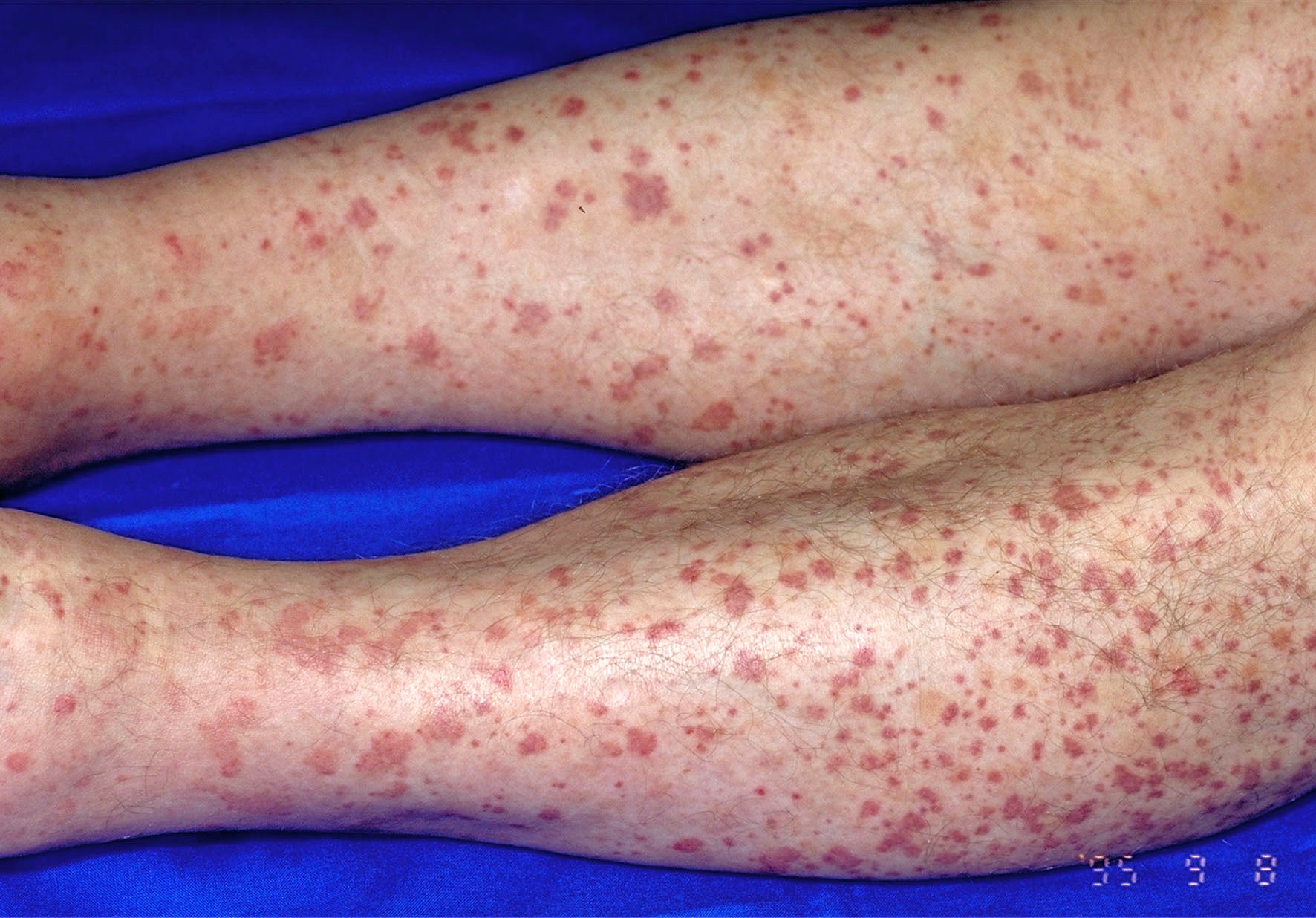 What Causes Rash On Lower Legs