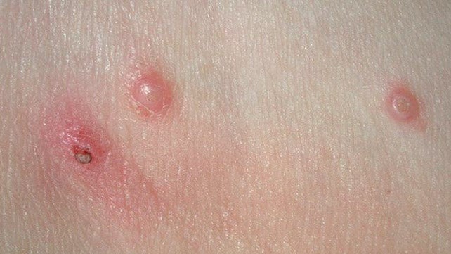 eczema open wound treatment