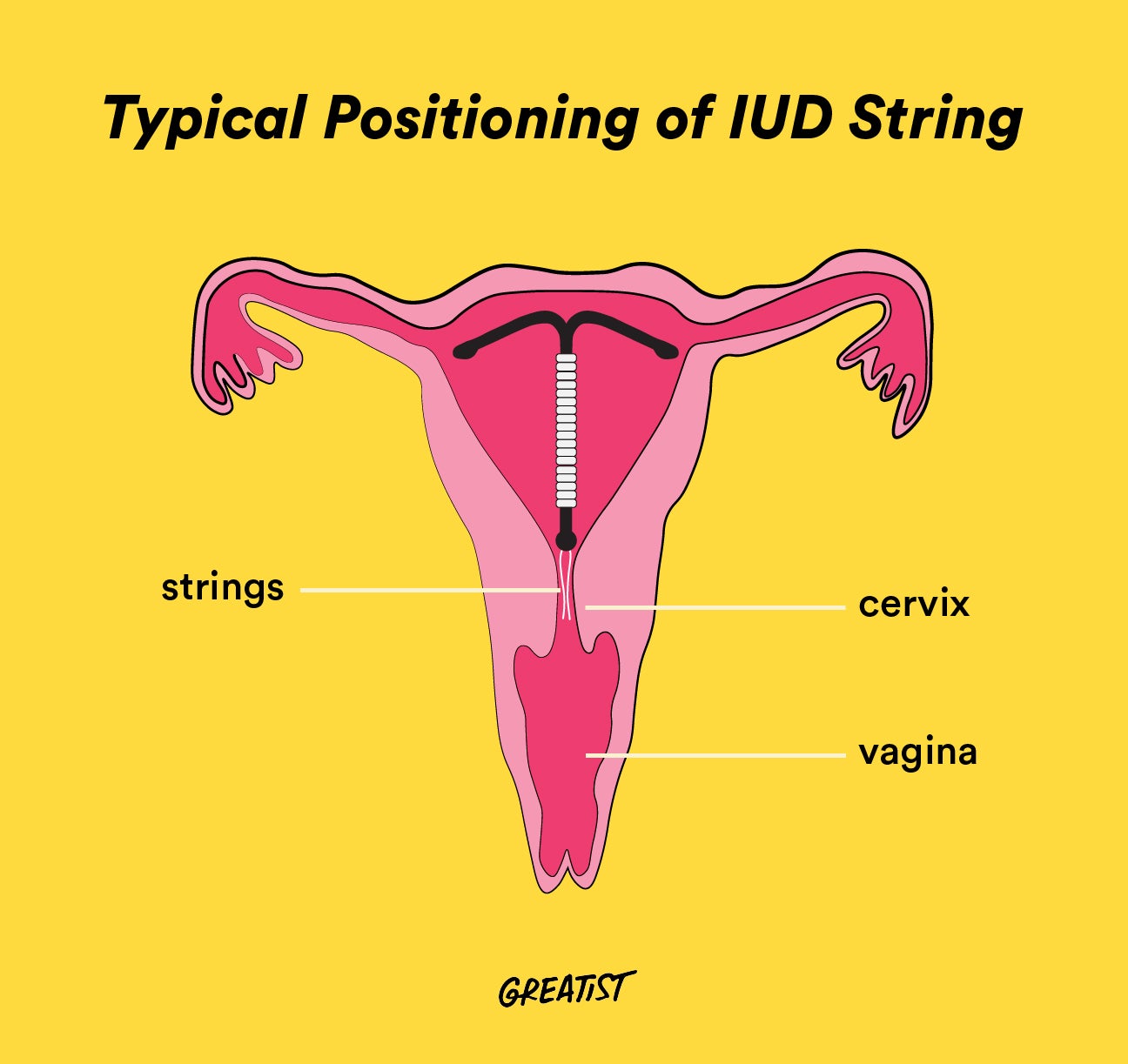 Feel iud strings can partner Sex With