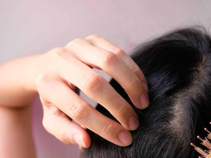 Hair Loss in Women: 14 Treatments for Females