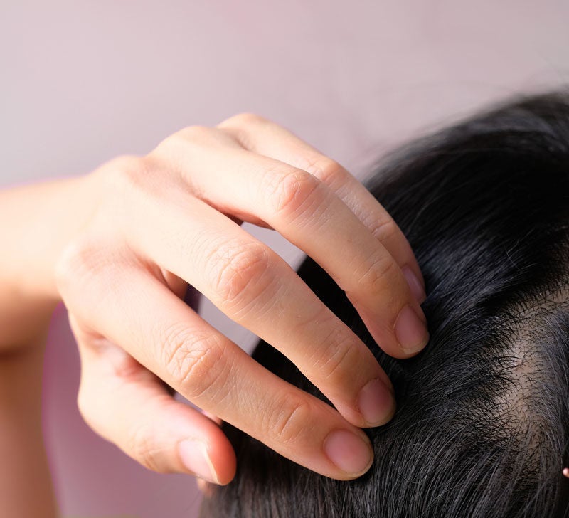 Hair Loss In Women 14 Treatments For Females