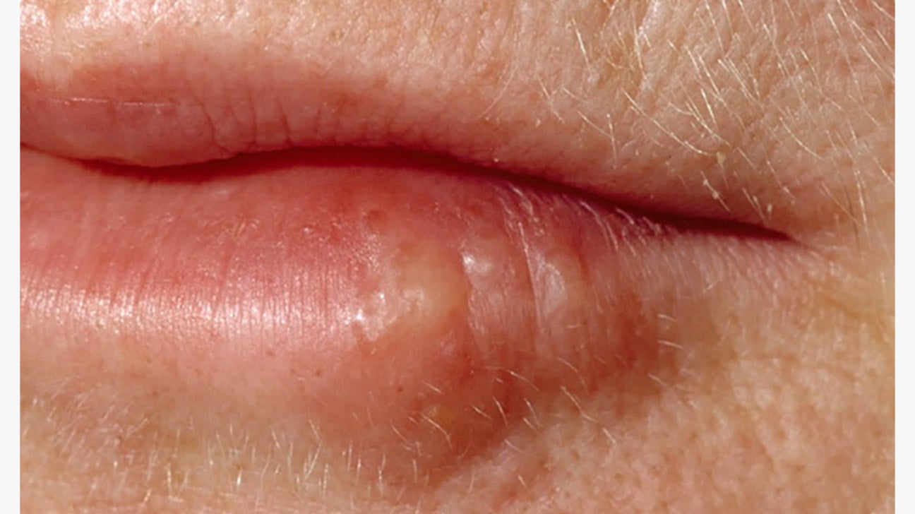 Cold Sore Stages How They Feel Pictures And Treatment