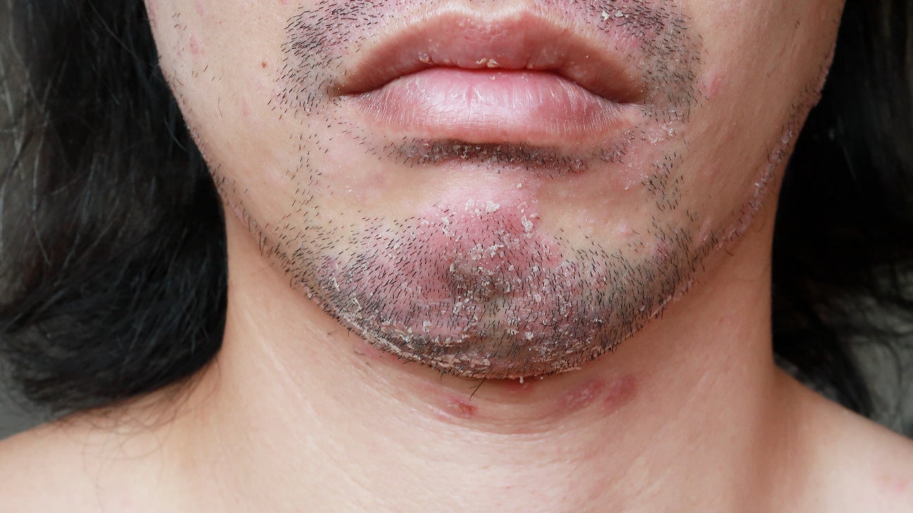 what triggers psoriasis on face
