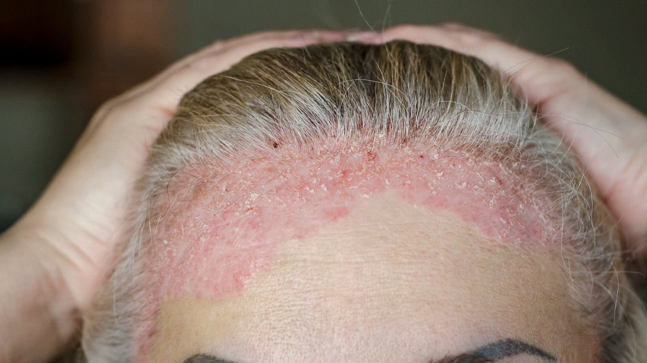 Scalp Psoriasis: Symptoms, Causes, and Treatments | Greatist