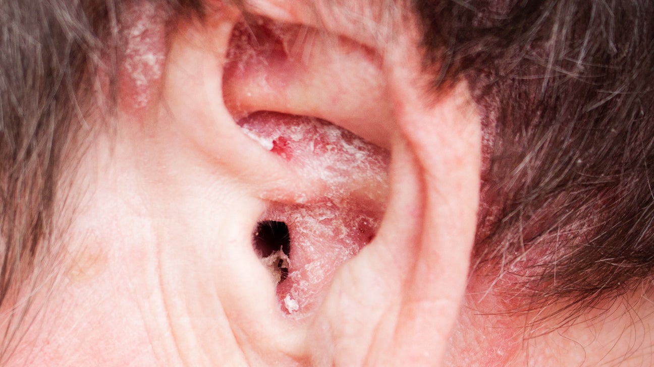 Scalp psoriasis around the ear
