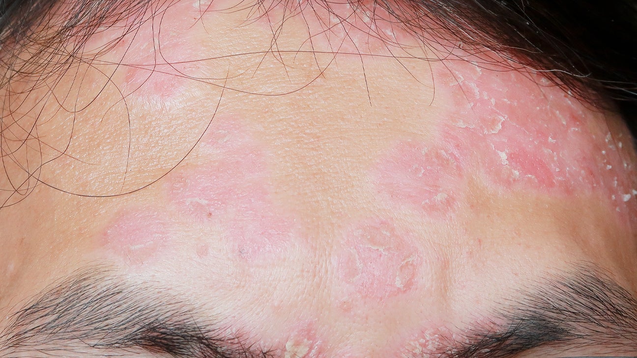 hairline psoriasis