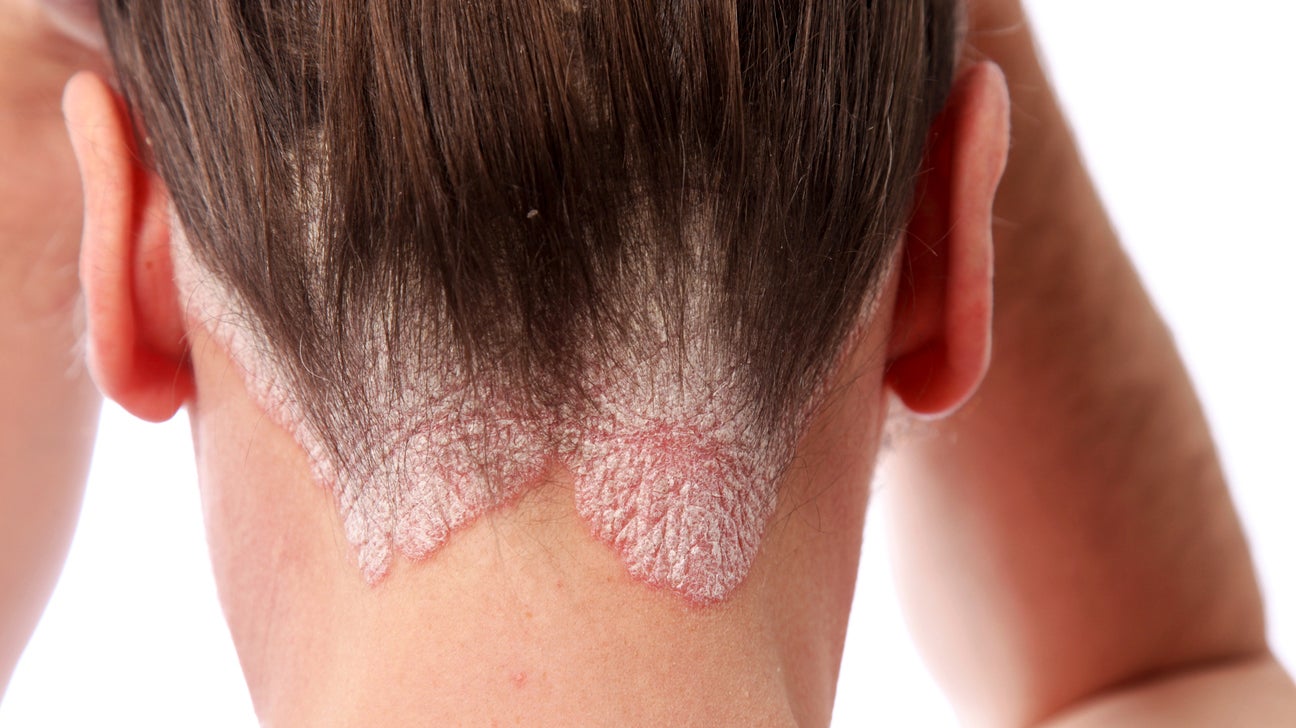 plaque psoriasis of scalp