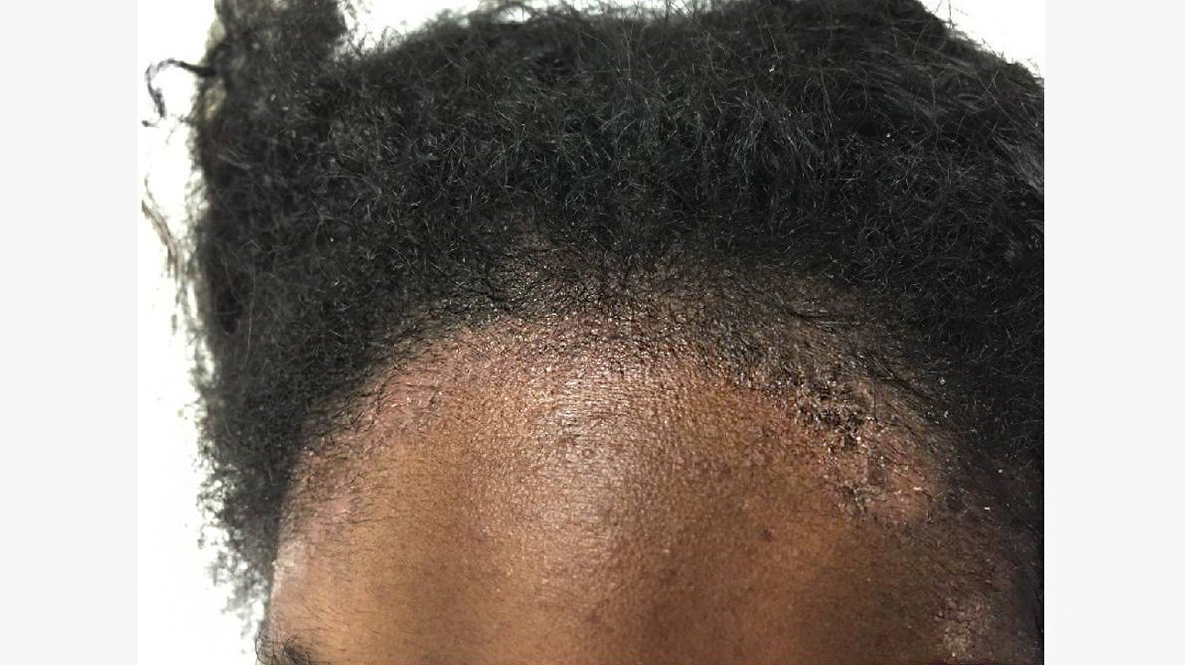 scalp psoriasis